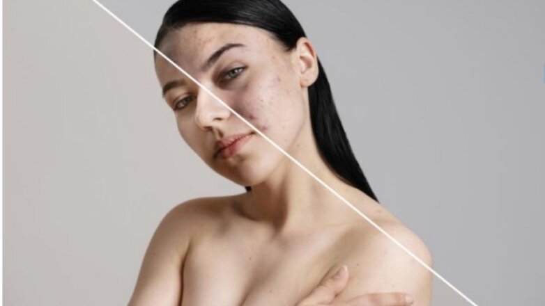 Πως να αφαιρέσουμε την ακμή;