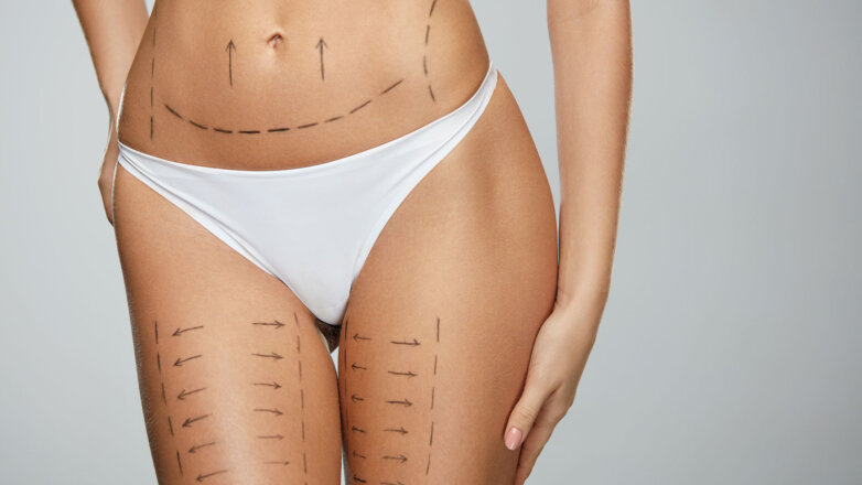 Λιπογλυπτική: Σμιλεύοντας τις ατέλειες του σώματος