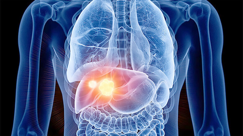 Οι παράγοντες κινδύνου για ηπατοκυτταρικό καρκίνωμα σε ασθενείς με κίρρωση ήπατος