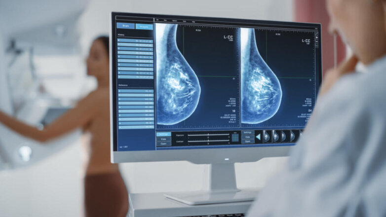 Η αξιολόγηση της μαστογραφίας με μεθόδους τεχνητής νοημοσύνης είναι ισάξια της κλασικής μεθόδου