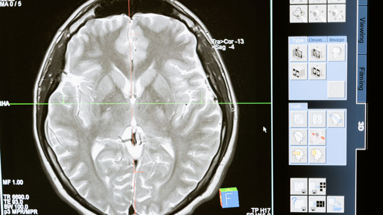 Γεγονός η πρώτη “κβαντική θεραπεία” κατά του καρκίνου; Νανοσωματίδια προκαλούν τον θάνατο σε κύτταρα γλοιοβλαστώματος