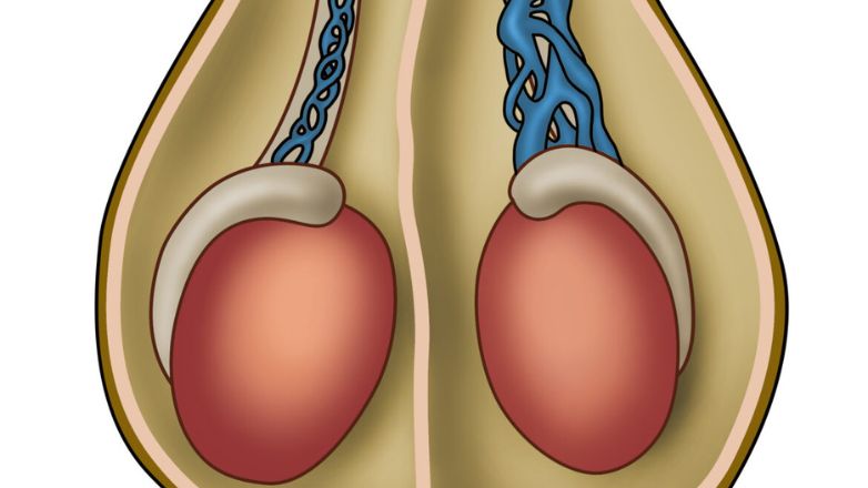 Πώς θεραπεύεται η κιρσοκήλη;