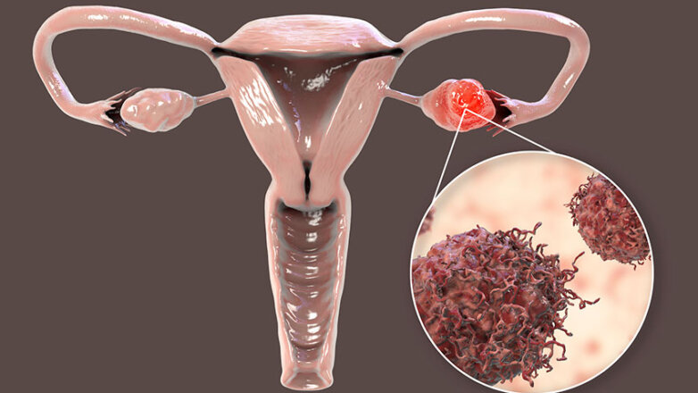 Νέα μελέτη για τον προσυμπτωματικό έλεγχο στον καρκίνο ωοθηκών