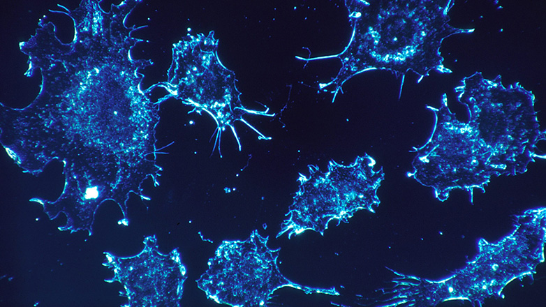 Έλληνες ερευνητές «σκοτώνουν» τον καρκίνο και τις μεταστάσεις του, χωρίς αφαίρεση και χωρίς φάρμακα