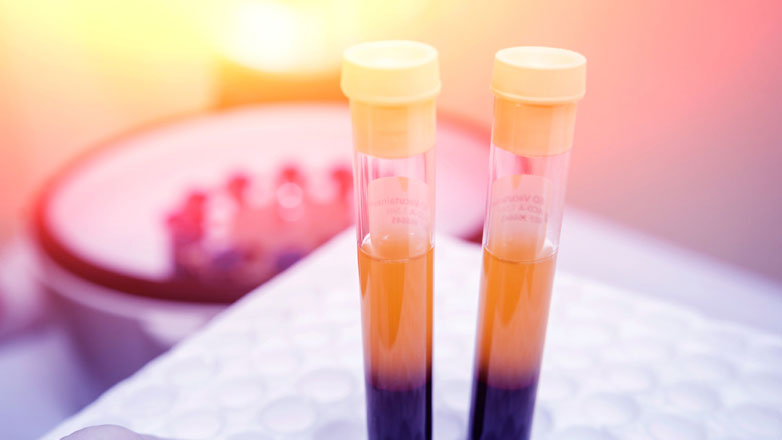 PRP (Πλάσμα Πλούσιο σε Αιμοπετάλια): Μια Ελπιδοφόρα Προσέγγιση για τη Θεραπεία της Στυτικής Δυσλειτουργίας