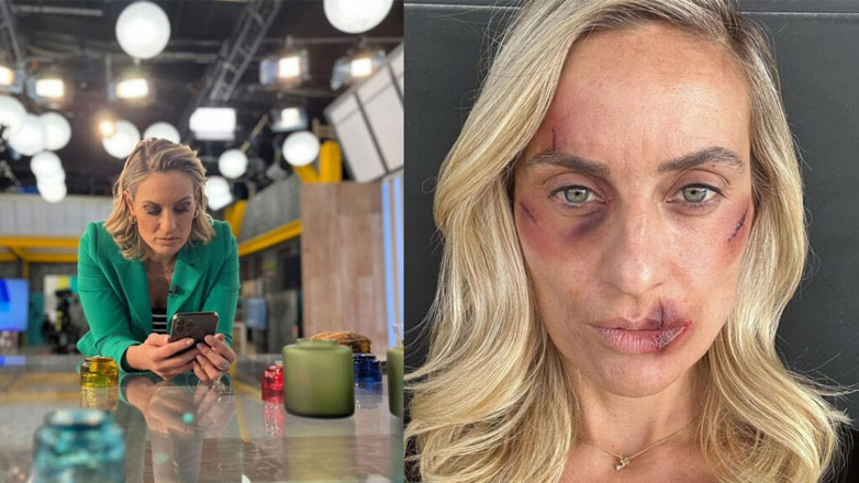 H Ελεονώρα Μελέτη φωτογραφίζεται με μώλωπες στο πρόσωπο και στέλνει ένα ηχηρό μήνυμα