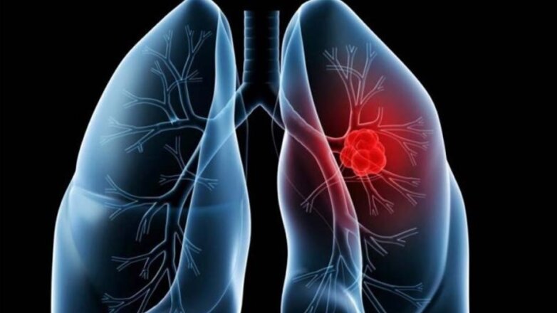 Καρκίνος του πνεύμονα: Μείωση κινδύνου και αύξηση ίασης Καρκίνος του πνεύμονα: Μείωση κινδύνου και αύξηση ίασης