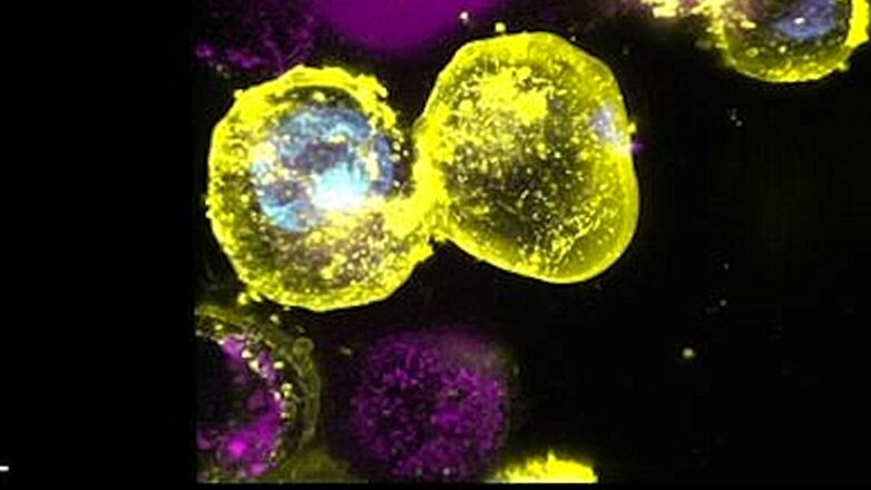 Μελέτη αποκαλύπτει γονίδιο που προκαλεί φλεγμονή