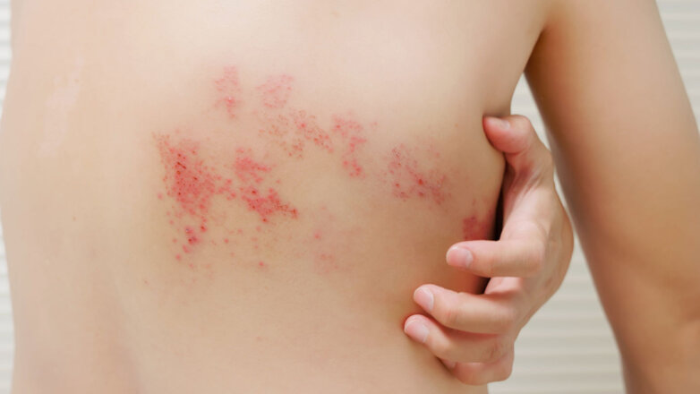 Γιατί ο έρπητας ζωστήρας έχει γίνει πιο συχνός μετά την πανδημία;