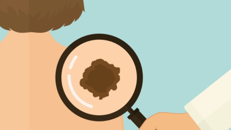 Επανάσταση στη θεραπεία του καρκίνου: Στο Metropolitan Hospital δωρεάν εμβολιασμός για ασθενείς με δερματικό μελάνωμα