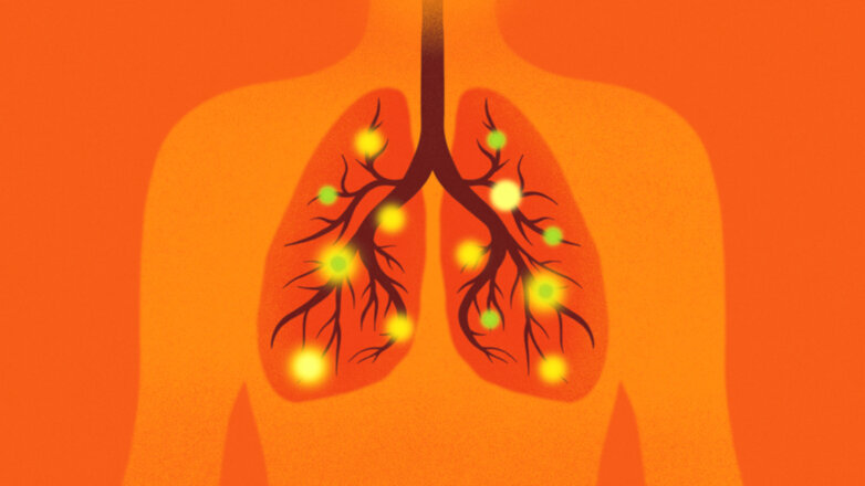 Το μυκόπλασμα της πνευμονίας – Τι συμβαίνει στην Ελλάδα