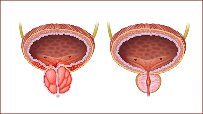 Επιπτώσεις της καλοήθους υπερπλασίας του προστάτη (BPH) στην ανδρική σεξουαλική υγεία