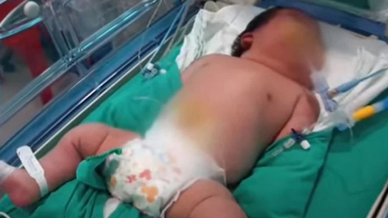 Το βαρύτερο μωρό στον κόσμο γεννήθηκε στη Χιλή
