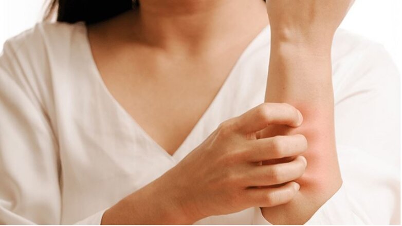 Οι επιστήμονες βρήκαν ένα απροσδόκητο έναυσμα εκζέματος Οι επιστήμονες βρήκαν ένα απροσδόκητο έναυσμα εκζέματος