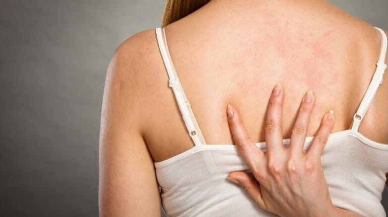 Σημαντική η ψυχολογική υποστήριξη για τους ασθενείς με ψωρίαση Σημαντική η ψυχολογική υποστήριξη για τους ασθενείς με ψωρίαση