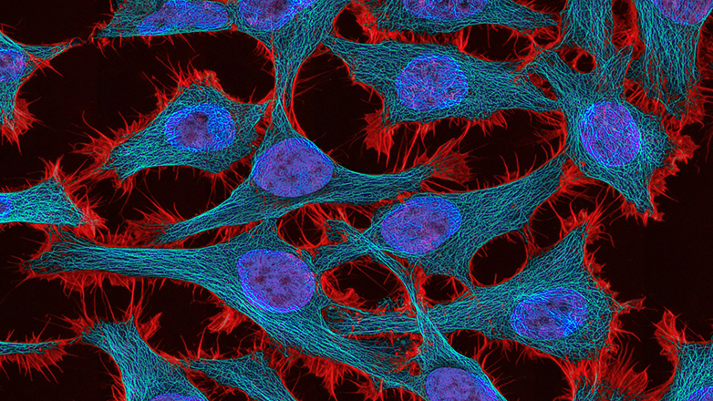 Η τεχνητή νοημοσύνη προβλέπει την ανταπόκριση του οργανισμού στη θεραπεία κατά του καρκίνου