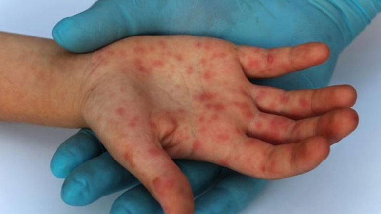 Τρεις επιδημίες ιλαράς στην Ελλάδα μέσα σε 19 χρόνια