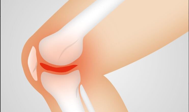 Τι συμβαίνει όταν μια επιγονατίδα εξαρθρωθεί