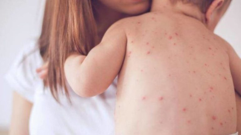 Ασθένειες που θεωρούνταν σχεδόν εξαφανισμένες, επιστρέφουν