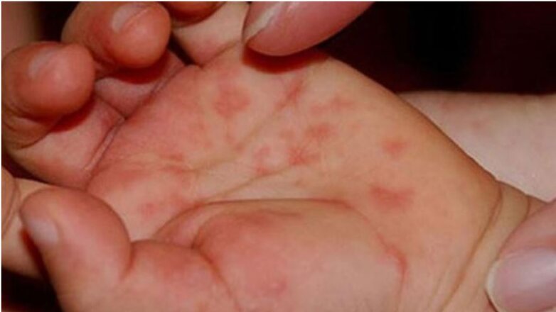 Έξαρση της ιλαράς σε ολόκληρη την Ευρώπη Έξαρση της ιλαράς σε ολόκληρη την Ευρώπη