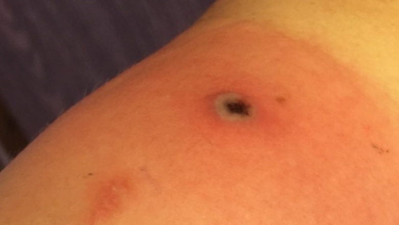 Ο πρώτος θάνατος από την «ευλογιά της Αλάσκας»