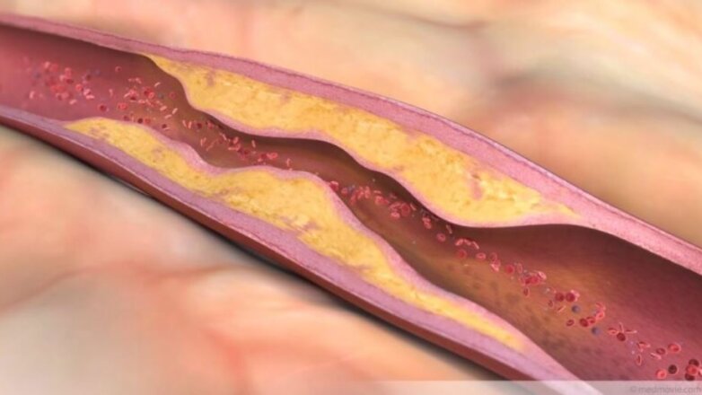 Η κατανάλωση πολλών πρωτεϊνών κάνει κακό στις αρτηρίες