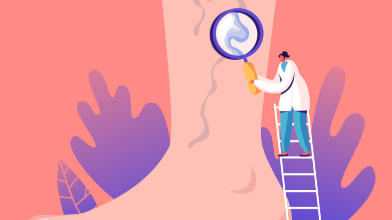 18 ερωτήσεις και απαντήσεις σχετικά με τους κιρσούς των κάτω άκρων