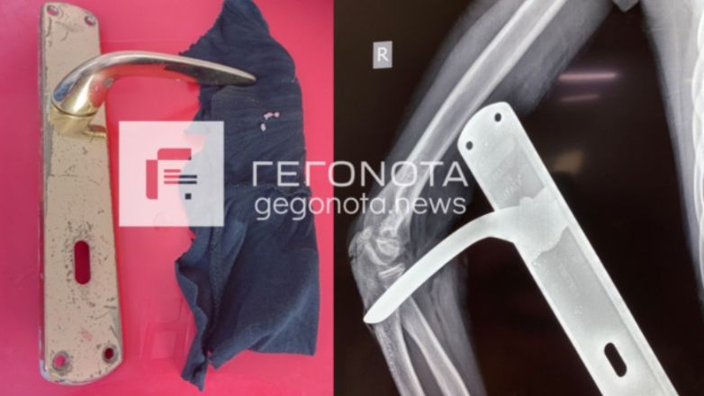 Βόλος: Πόμολο καρφώθηκε στο χέρι μαθητή – Ο γιατρός που το αφαίρεσε το επέστρεψε στο σχολείο