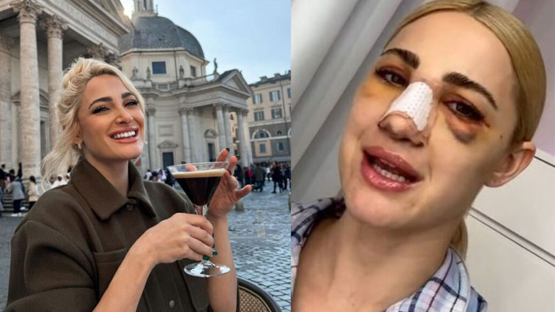 Ιωάννα Τούνη: Δείχνει το μελανιασμένο πρόσωπό της τρεις μέρες μετά την πλαστική στη μύτη