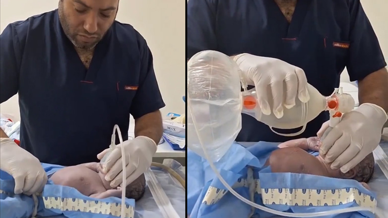 Γιατρός επαναφέρει νεογέννητο μωρό στη ζωή