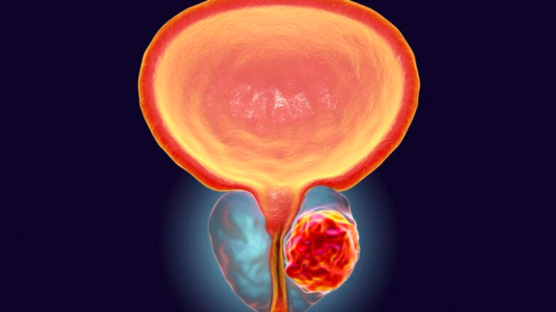 Kαλοήθης υπερπλασία του προστάτη: Σύγχρονη και οριστική λύση  