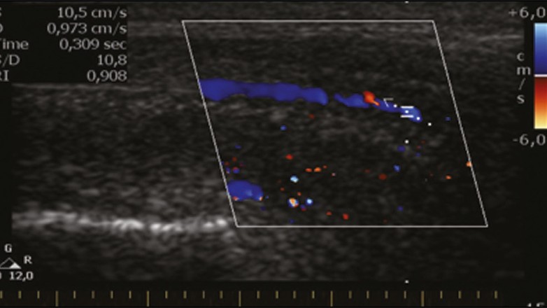 Doppler πέους: Ένας ολοκληρωμένος οδηγός