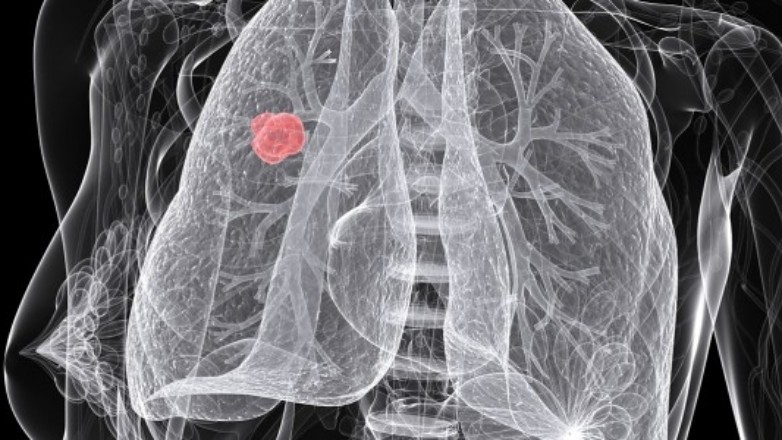 Μελέτη στις ΗΠΑ δείχνει ότι ο προσυμπτωματικός έλεγχος για τον καρκίνο του πνεύμονα δεν είναι ικανοποιητικός