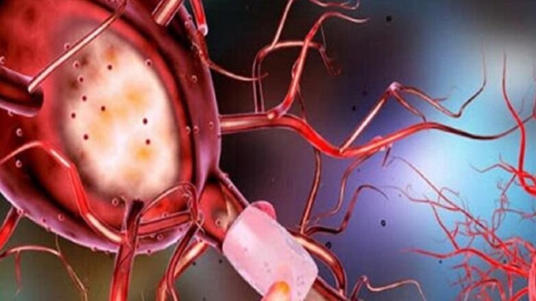 Φάρμακο για τον διαβήτη και την παχυσαρκία επιβραδύνει την ανάπτυξη της νόσου του Πάρκινσον