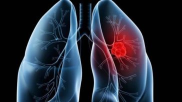 Καινοτόμος ανοσοθεραπεία κατά του καρκίνου του πνεύμονα, με ελληνική σφραγίδα