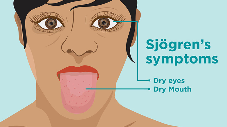 Πώς το σύνδρομο Sjögren μπορεί να επηρεάσει τη σεξουαλικότητα