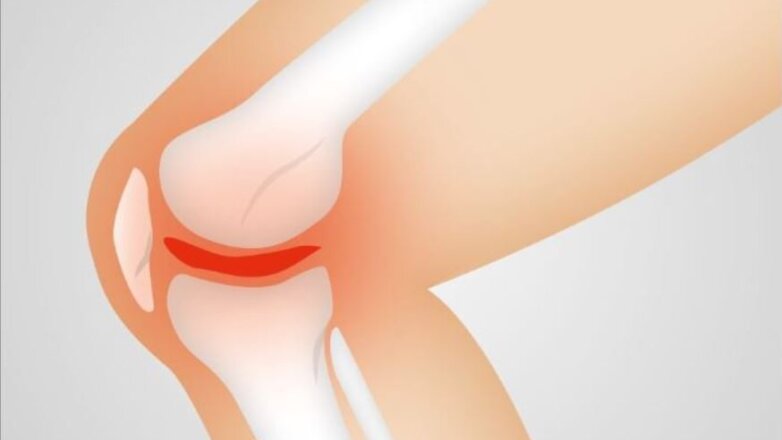 Πότε η άρση βαρών αυξάνει τον κίνδυνο οστεοαρθρίτιδας γόνατος