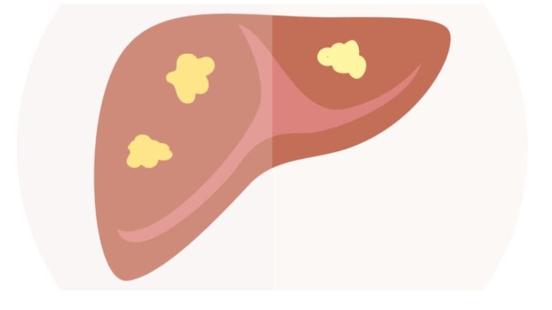 Η διαλείπουσα νηστεία προστατεύει από τη φλεγμονή και τον καρκίνο του ήπατος