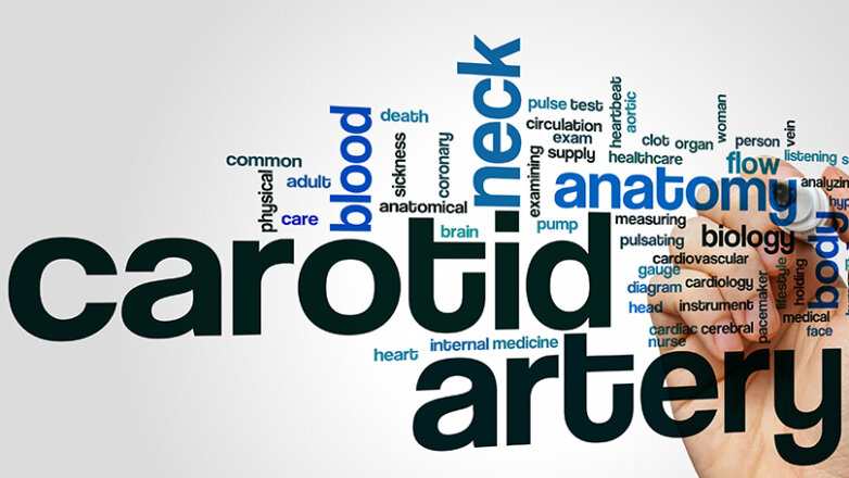 Στένωση καρωτιδικής αρτηρίας: Μία σιωπηλή απειλή