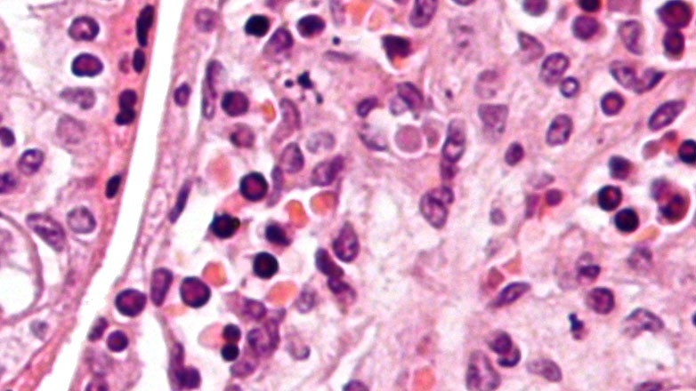 Επτά ερωτήσεις και απαντήσεις για τη λοίμωξη από παρβοϊό Β19 από την Ελληνική Εταιρεία Λοιμώξεων