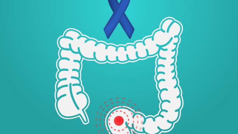 Σύγχρονες μέθοδοι αντιμετώπισης καρκίνου του ορθού