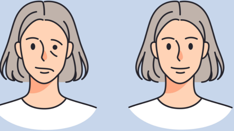 Παράλυση προσώπου: Αίτια και αντιμετώπιση