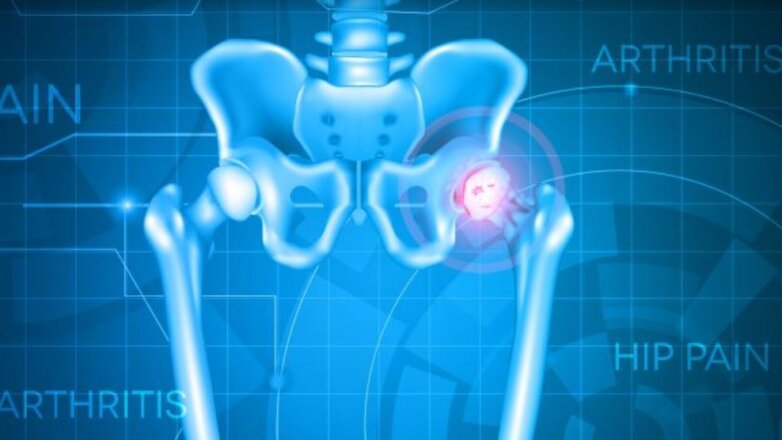 Εξελίξεις στην ολική αρθροπλαστική ισχίου