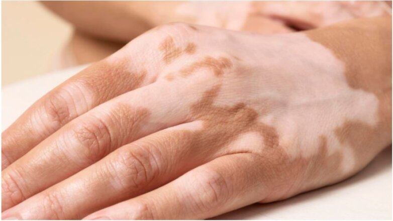 Απαντήσεις στις πιο συχνές ερωτήσεις για τη λεύκη