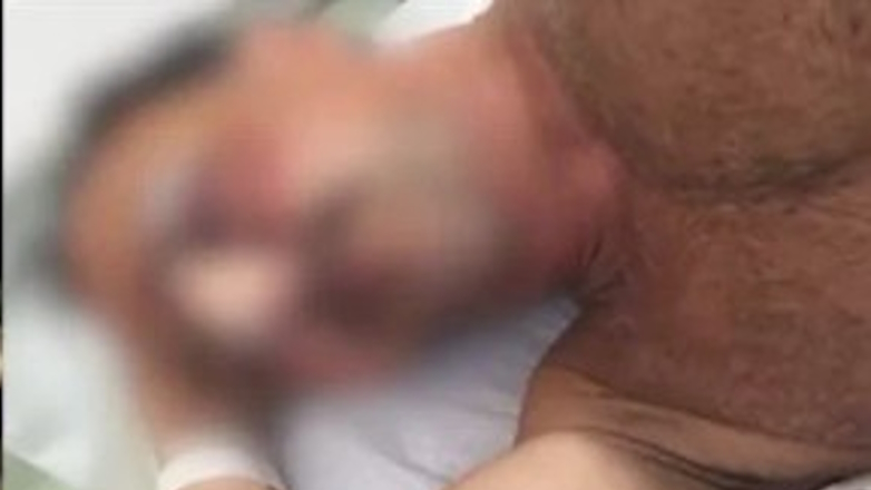 Με 60 ράμματα στο κεφάλι το θύμα των «νταήδων» στην Κρήτη