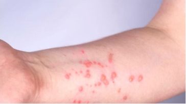 Ευλογιά των πιθήκων: Οι οδηγίες του ΕΟΔΥ για τους ταξιδιώτες