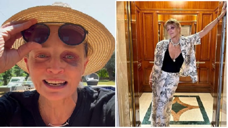 Γιατί η Σάρον Στόουν εμφανίστηκε με «μαυρισμένο μάτι»