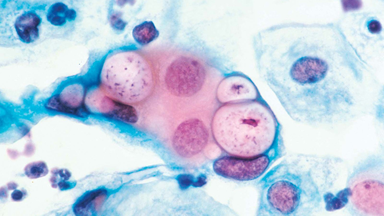 Χλαμύδια: Συμπτώματα, μετάδοση και θεραπεία