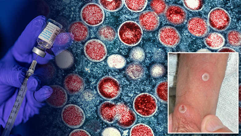 Συναγερμός στην Ευρώπη για την Ευλογιά των Πιθήκων – Το πρώτο κρούσμα στη Σουηδία