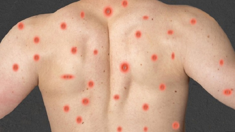 Η αναζωπύρωση της Mpox στην Αφρική